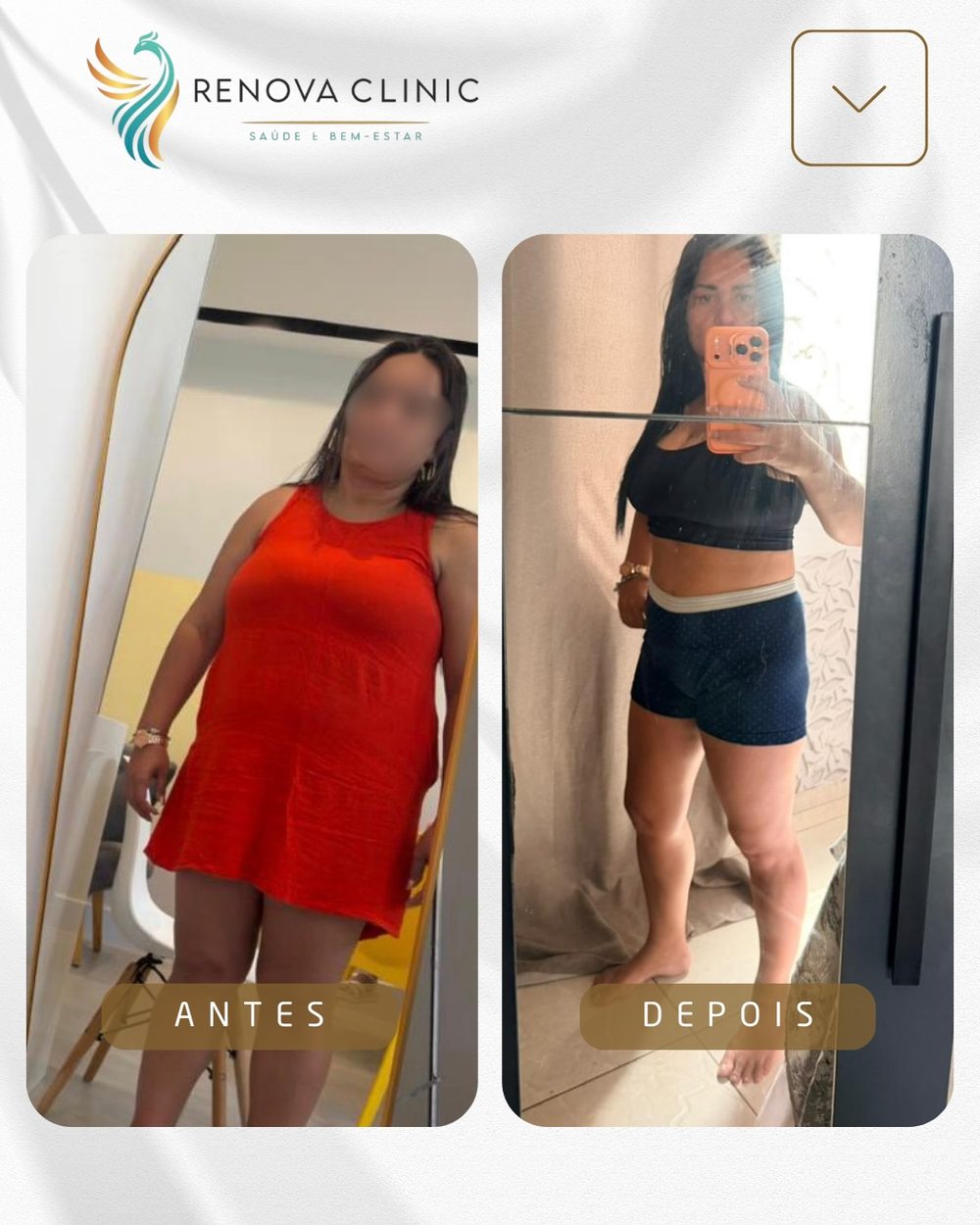 Resultado emagrecimento feminino Renova Clinic